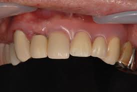 上の前歯の欠損をさりげなく治療した症例