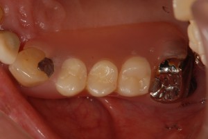 右上にノンクラスプ義歯を入れた症例
