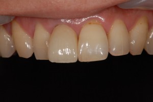 右上前歯を保険治療から自費治療のメタルボンドにやり替え、さらなる審美性追求によりオールセラミックにやりかえた症例