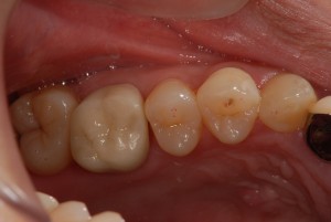 上の奥歯をジルコニアセラミックスで修復した症例