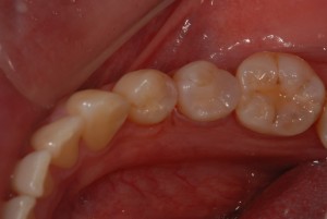 左下奥歯にハイブリッドセラミックインレーをセットした症例