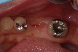 右下６歳臼歯部に抜歯即時インプラントを行い治癒期間の短縮を期待した症例