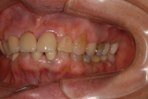 歯冠長増大術を応用しインプラントとの咬合の調和を図った症例
