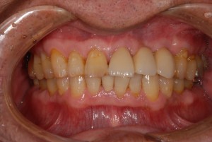抜歯即時埋入で治療期間と短縮し審美回復した症例