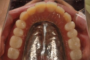 下顎に２本インプラントを埋入し総入れ歯の維持とした症例