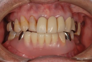 上顎にインプラント　下顎にノンクラスプ義歯をいれて対応した症例