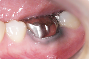 入れ歯と金属アレルギーの関係について