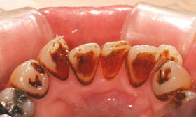 喫煙と虫歯は何か因果関係はありますか？？