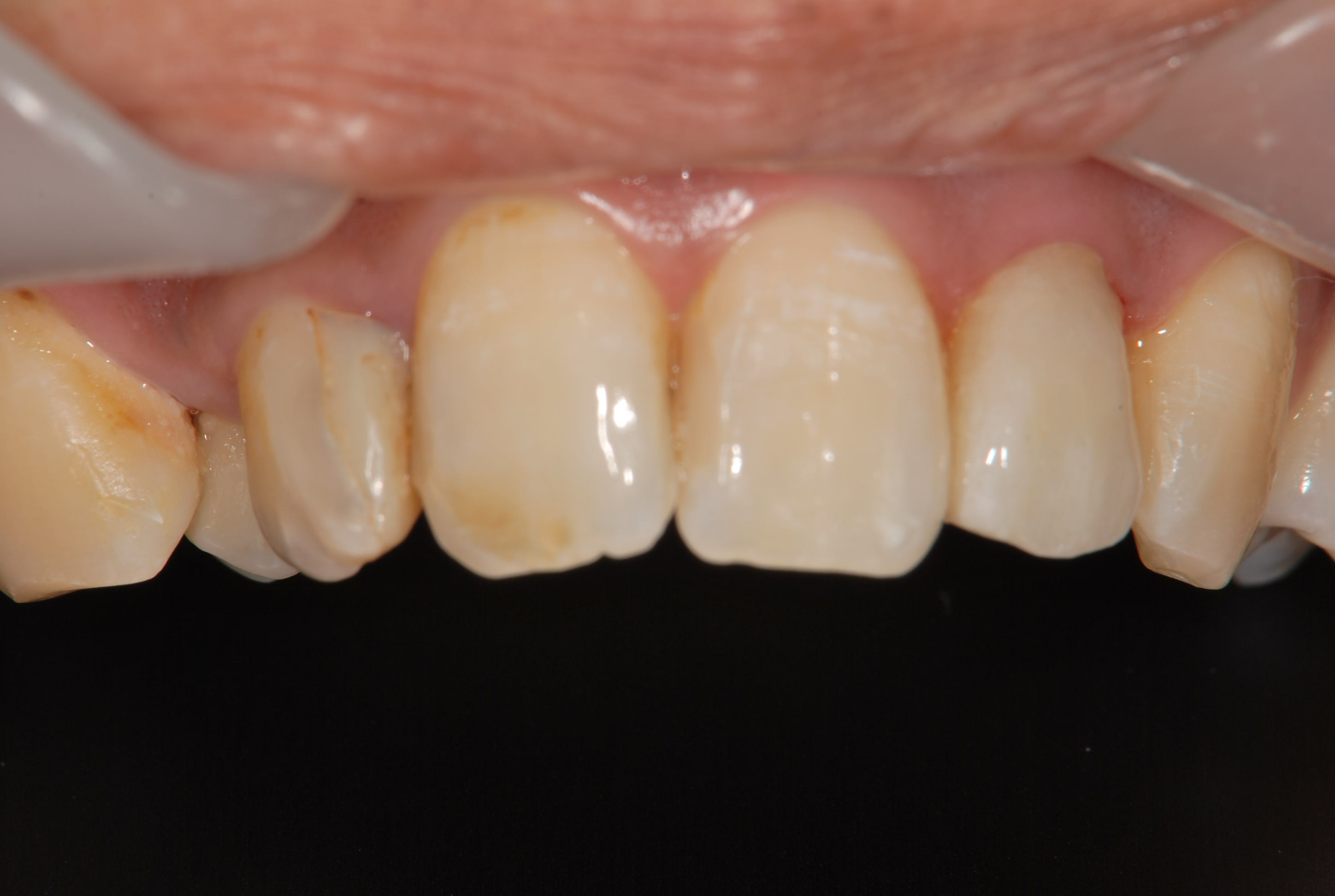 前歯 の 治療 セラミック